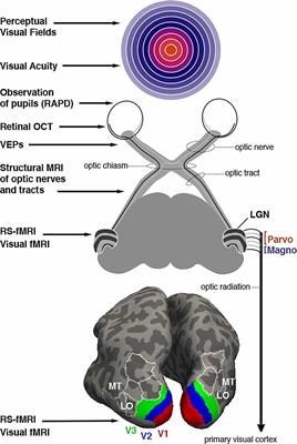 Visually driven functional MRI techniques for characterization of optic neuropathy